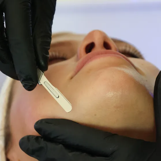 dermaplaning at monroe medspa