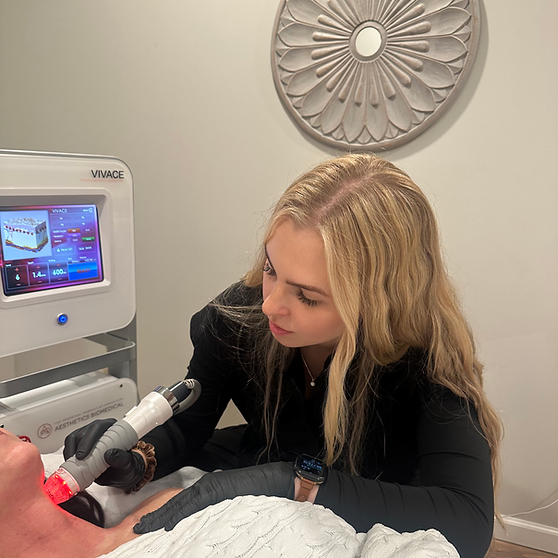 vivace rf microneedling treatment at monroe medspa