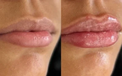 dermal fillers before and after photo by monroe medspa in rochester ny