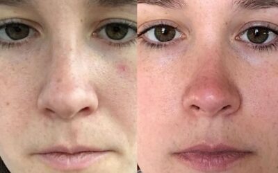 bbl before and after photo by monroe medspa in rochester ny x