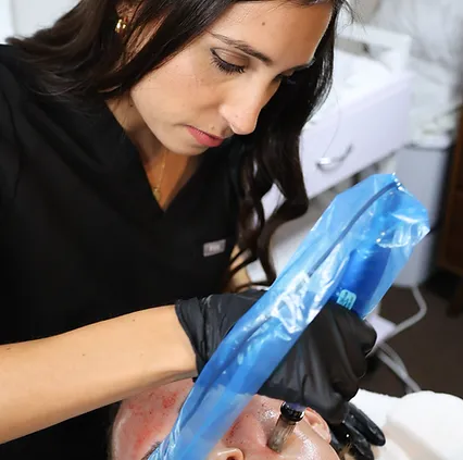 woman getting microneedling treatment at monroe medspa