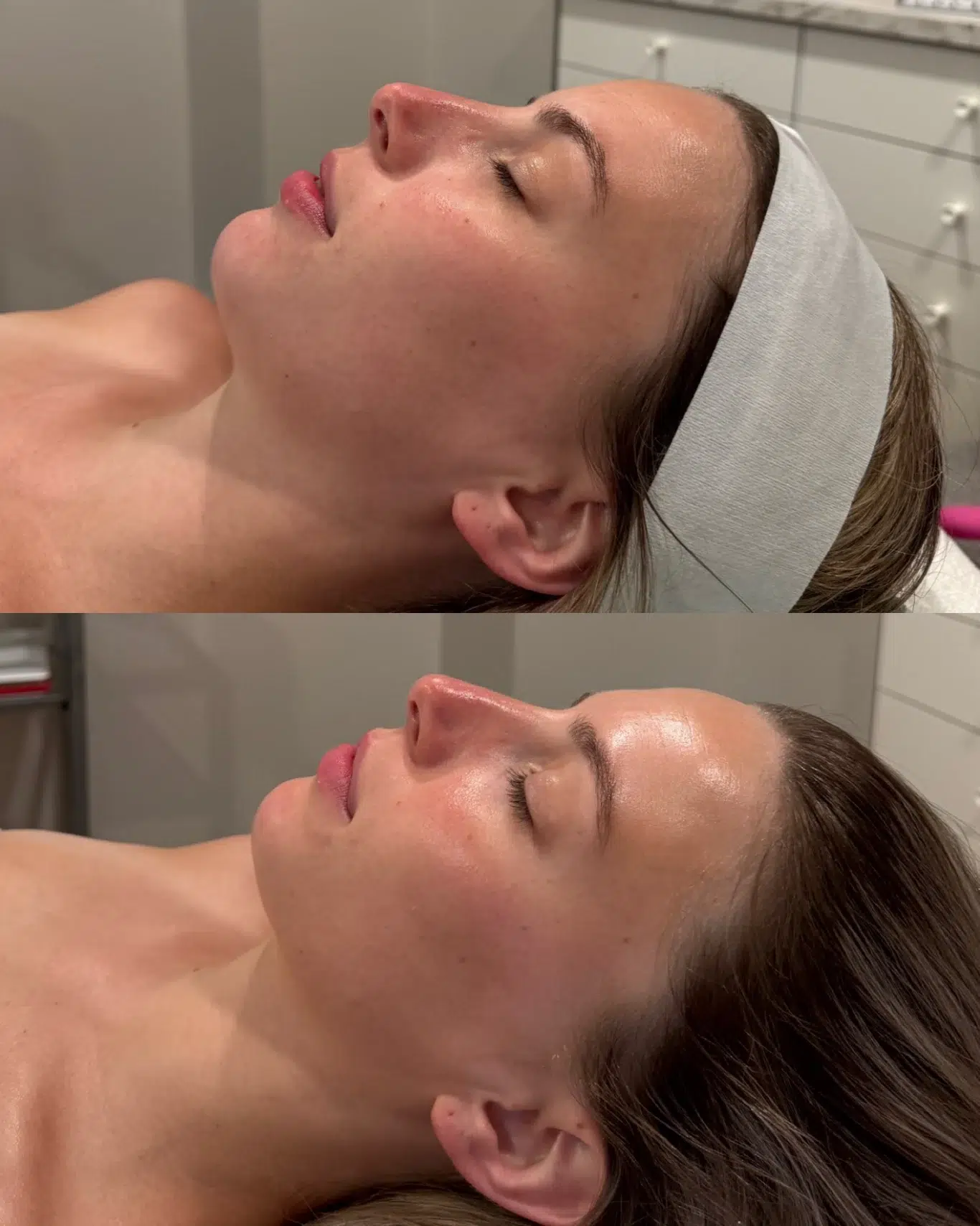 hydrafacial before and after hydrated radiant complexion woman's face before and after deep-cleansing hydrafacial with improved skin texture and hydration