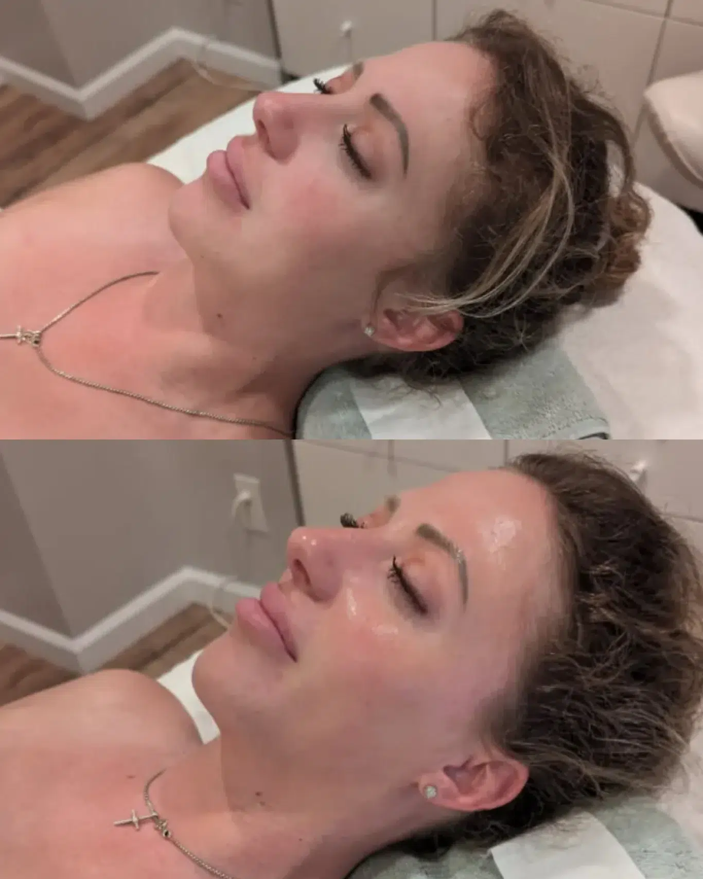 hydrafacial deep cleanse hydration results side profile hydrafacial before and after photo showing brighter, more radiant skin